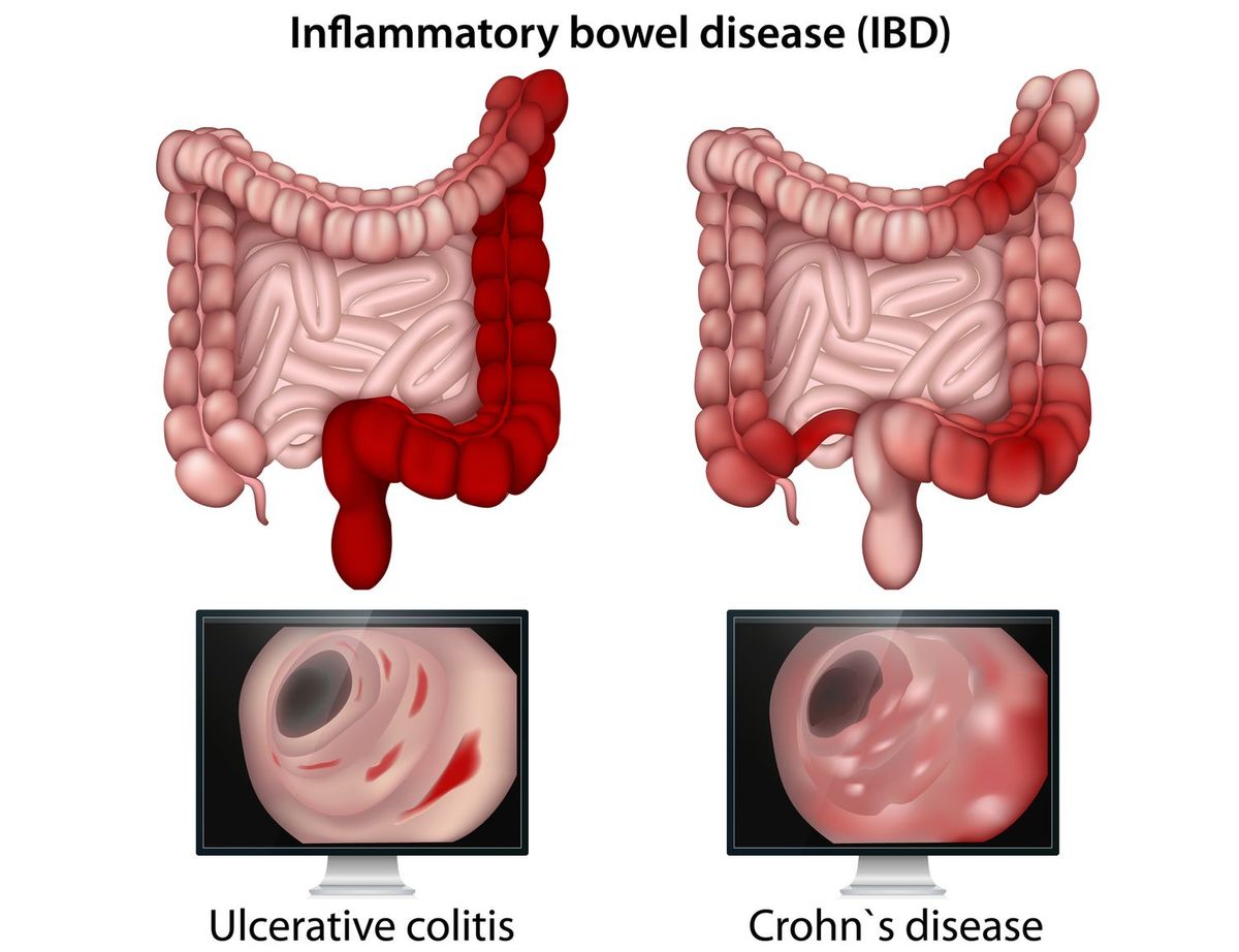 Inflammatory Bowel Disease (Ulcerative colitis)