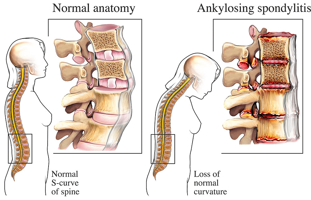 Anatomy of Ankylosing Spondylitis 