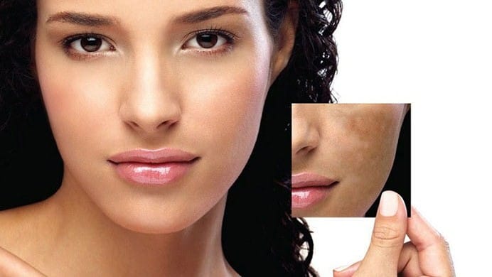 Skin Hyperpigmentation Organic Treatment