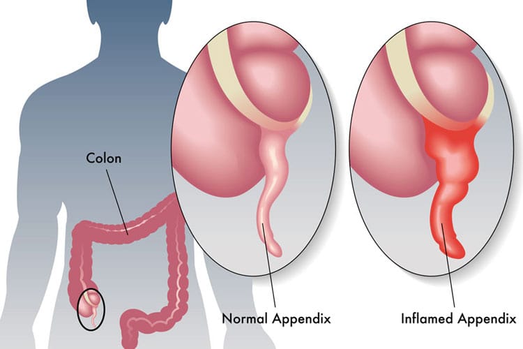 Normal and inflamed Appendix