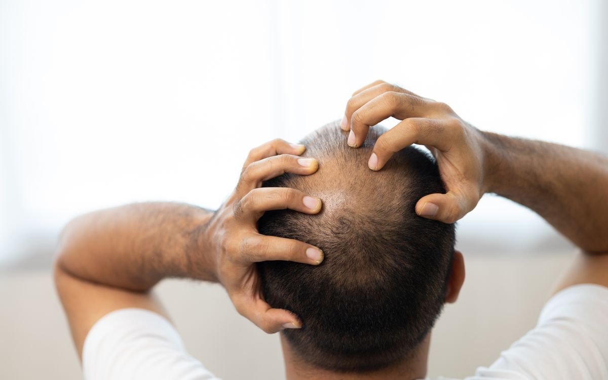 What Are Best Home Remedies For Baldness? Know Here!