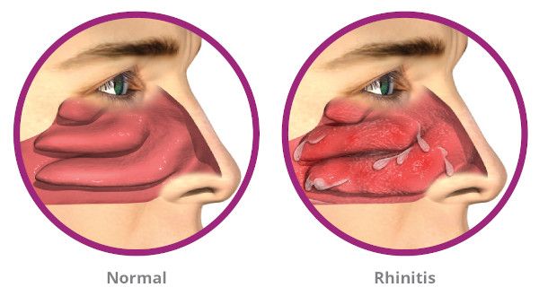 Tips For Treating Allergic Rhinitis Naturally at Home
