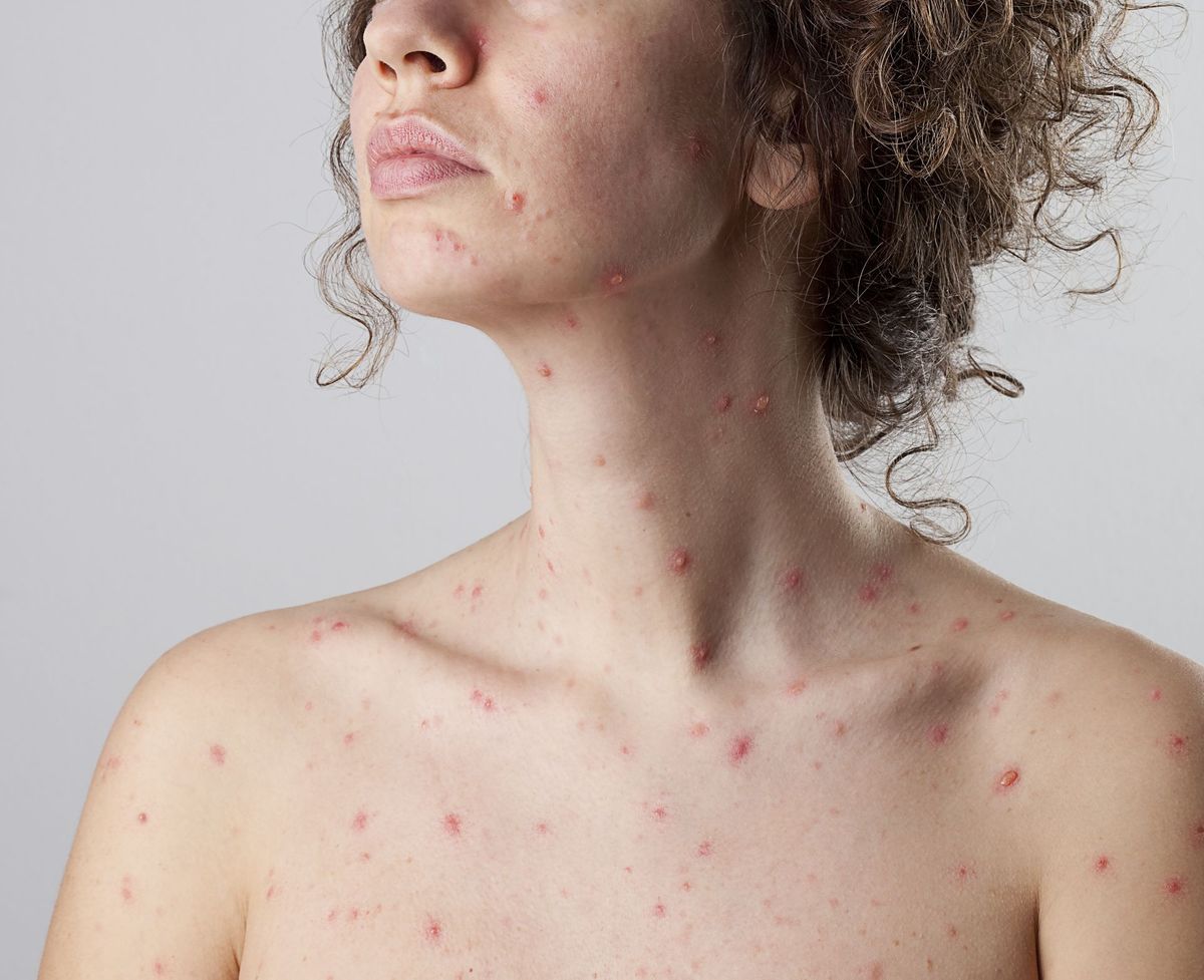 How To Cure Chicken Pox Using Home Remedies
