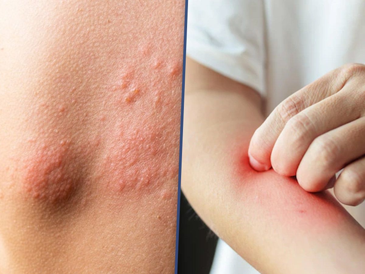 Eczema: How To Treat Using Home Remedies