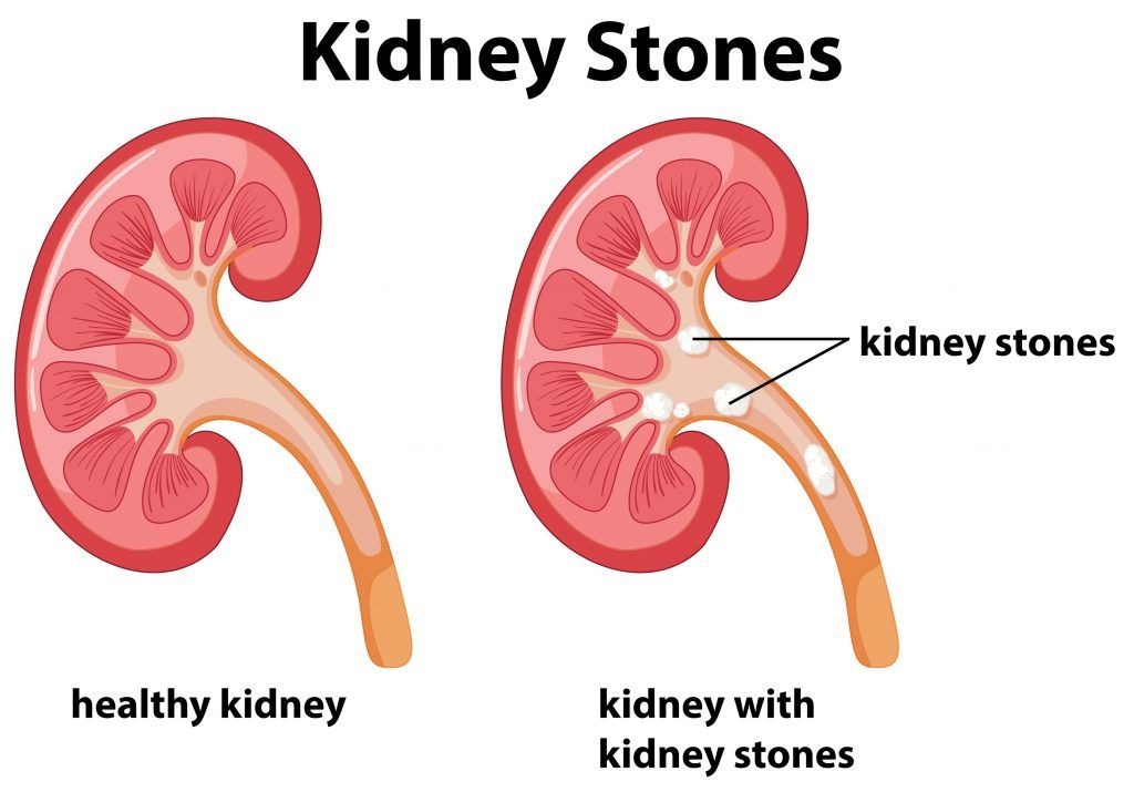 How To Treat Kidney Stone- 17 Home Remedies