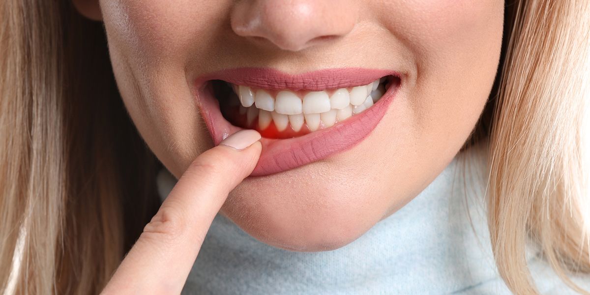 How To Cure Swollen Gums- Five Remedies