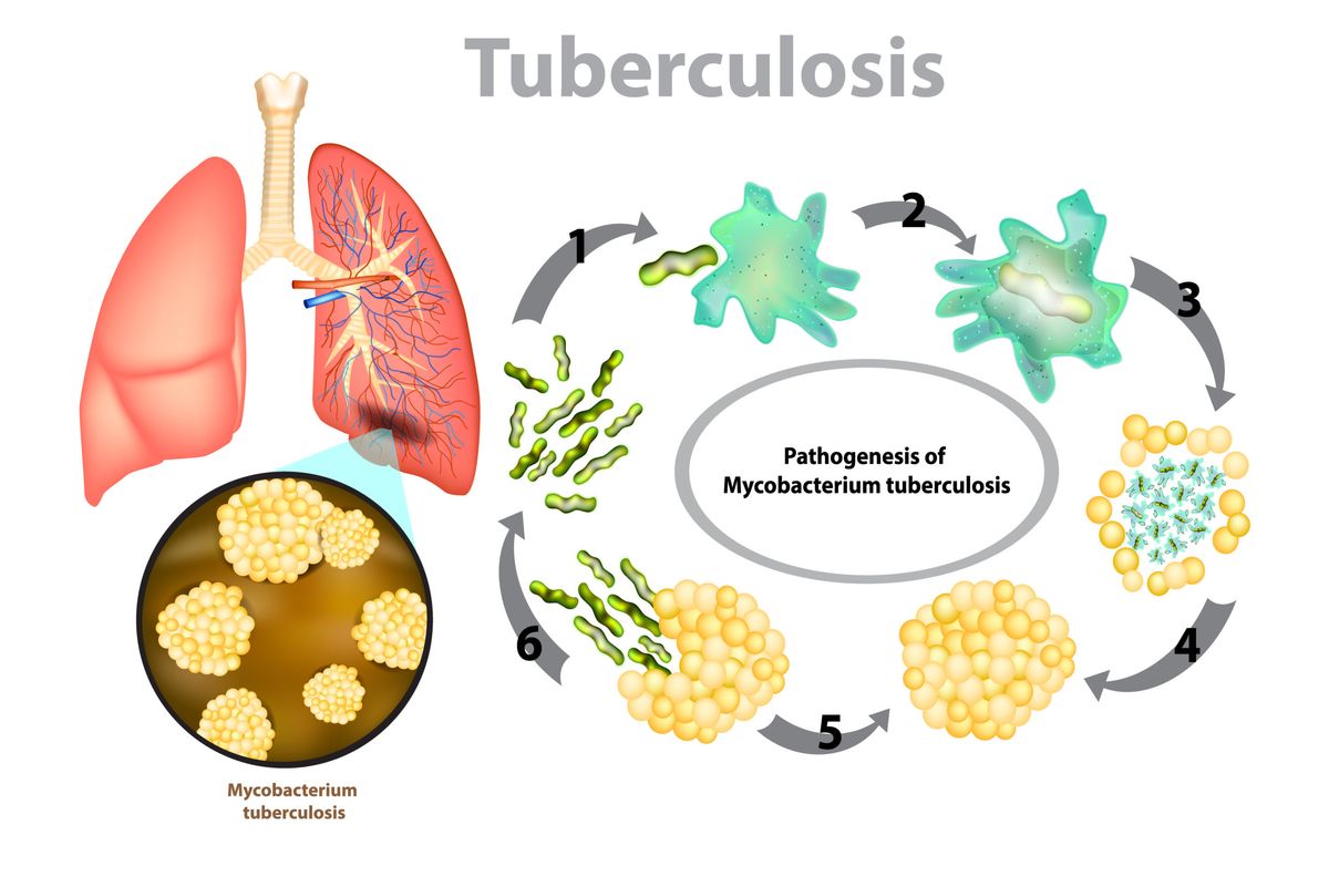 How To Treat Tuberculosis (TB)- 13 Remedies