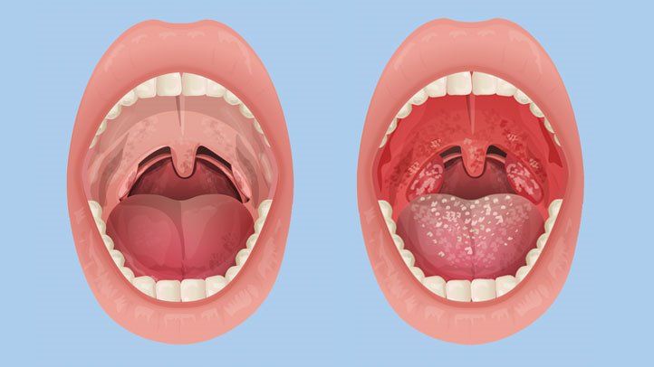 How To Treat Tonsillitis? 6 Remedies