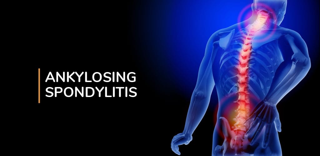 Ankylosing Spondylitis Treatment: Natural Solutions