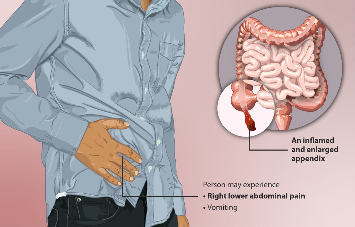 Appendix Pain: A Guide to Understanding the Causes, Symptoms, Prevention, and Treatment Options!