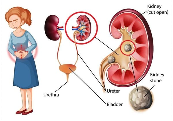 kidney stones topic in hindi